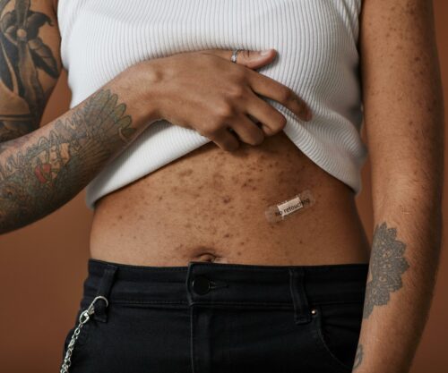 Body acne. Picture: Pexels